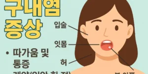 구내염
